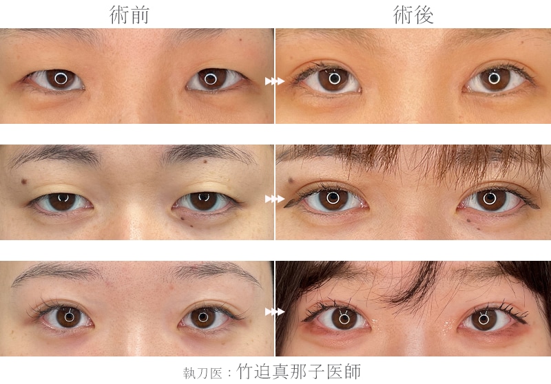 埋没から全切開までお任せください