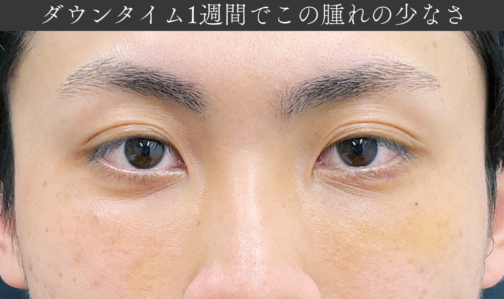 お仕事への影響も最小限に!短いダウンタイムでしっかりと効果を実感できます