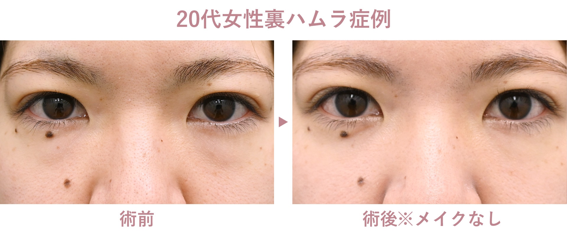 20代女性裏ハムラ