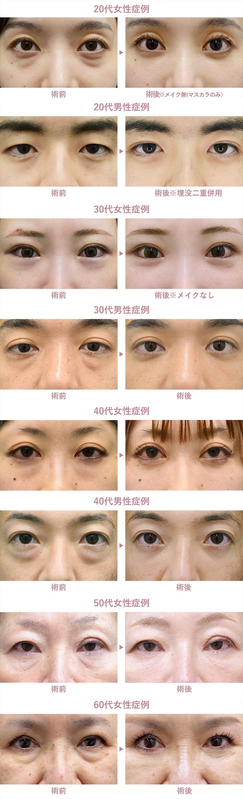 目の下の切らないクマ・たるみ取り症例