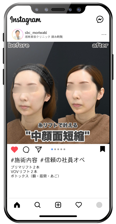 糸リフトで、中顔面短縮。<br />
20代女性たるみ予防