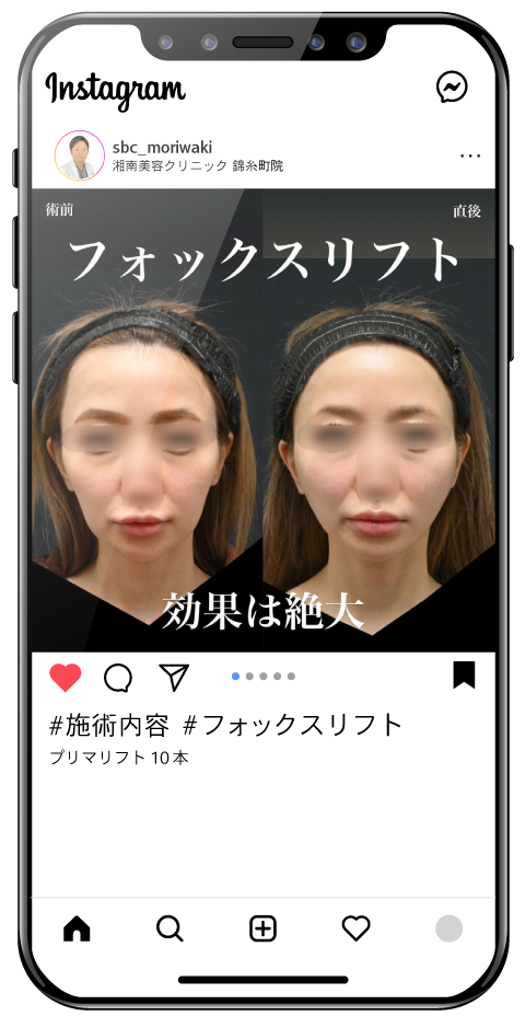 直後でもこの仕上がり。<br />
30代女性口横リフト