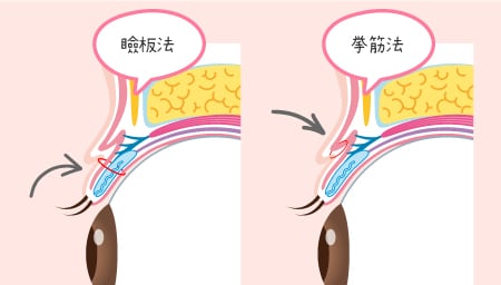 埋没法