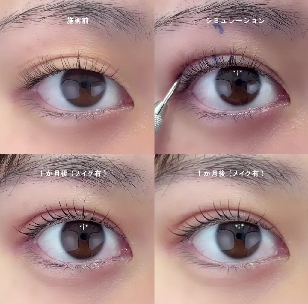 切らない眼瞼下垂術<h2>デカ目術（切らない眼瞼下垂術）</h2><p><strong>