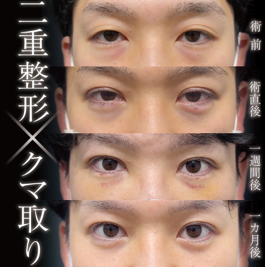 20代からも可能！<br />
<h2>6. クマ取り（経結膜脱脂法）</h2><p>