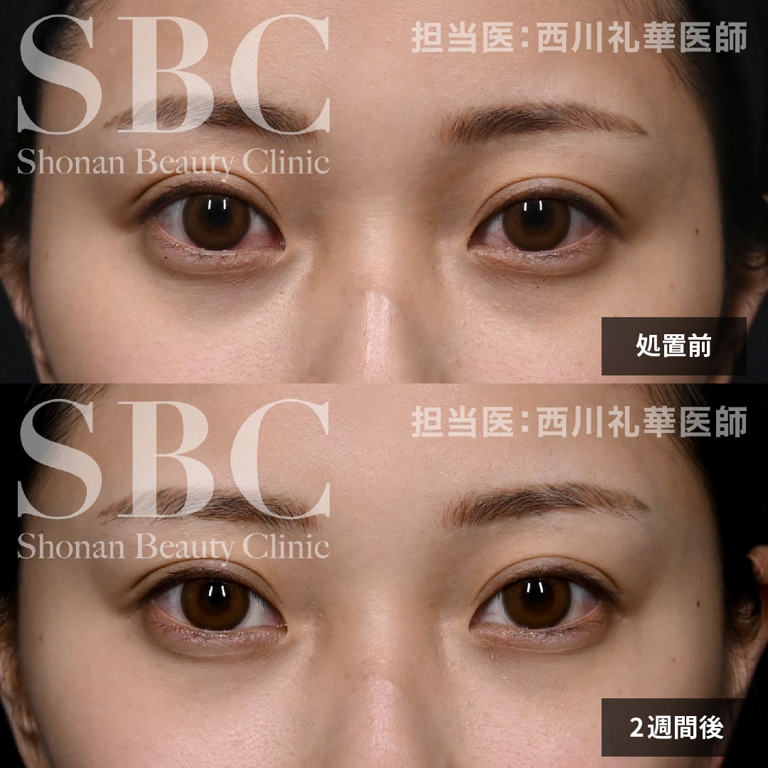 処置前 ▶︎ 2週間後