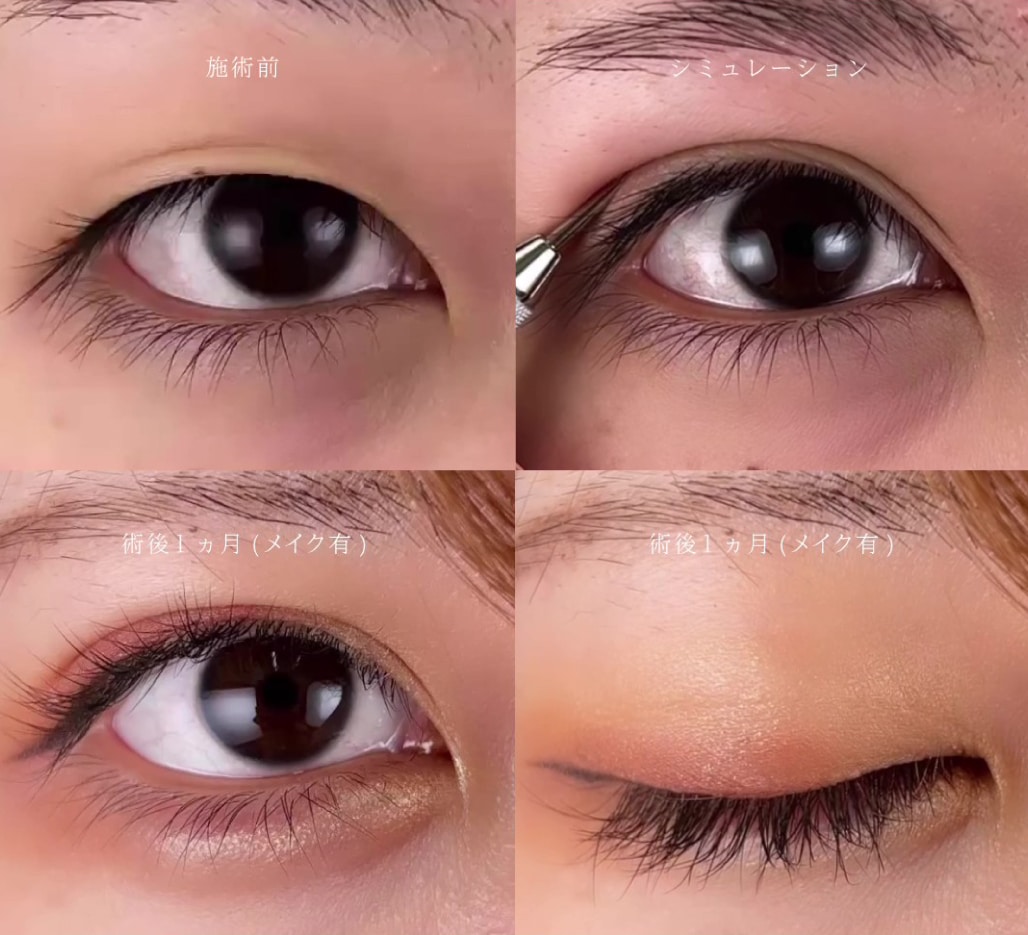 目元の印象アップ♬<br />
<h2>5. 涙袋ヒアルロン酸</h2><p>