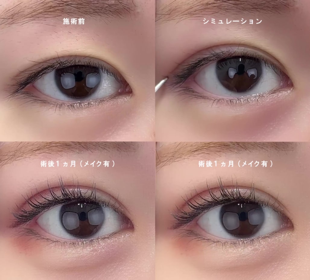 柔らかい印象の目元に<h2>3. 目尻切開法</h2><p><strong>