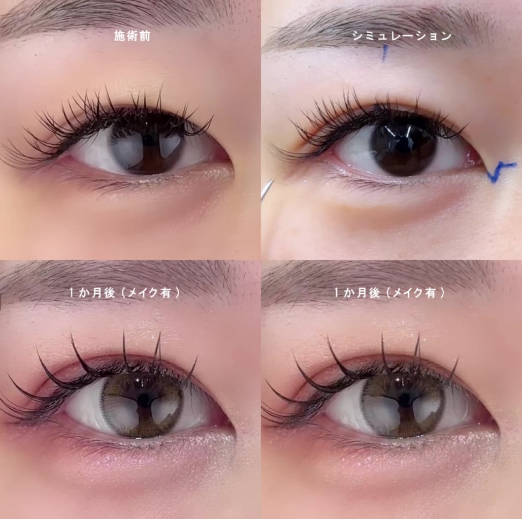 憧れのアーモンドアイへ。<br />
<h2>目頭切開法</h2><p><strong>