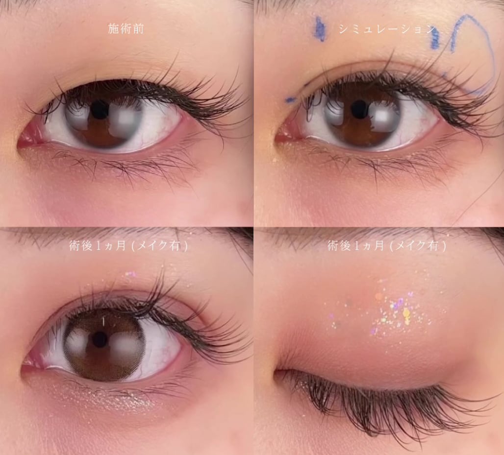 自然癒着セット<br />
<h2>4. まぶたの脂肪取り（マイクロリポサクション）</h2>