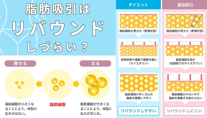 脂肪吸引の仕組みは？
