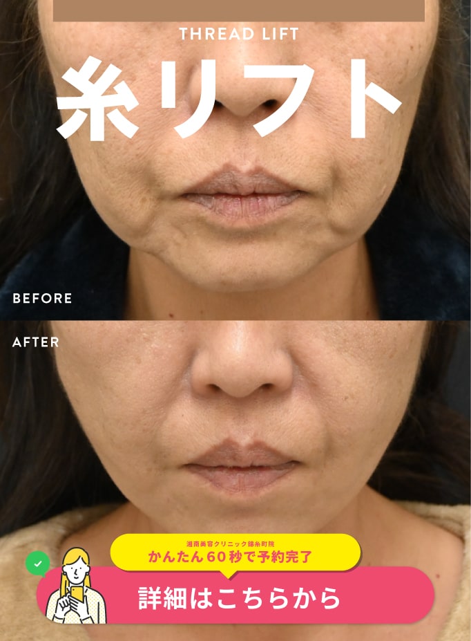 【糸リフト】お顔のたるみを改善するなら糸リフトがおススメ！