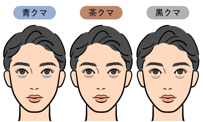 青クマ・黒クマ・茶クマ…あなたのクマはどのタイプ?