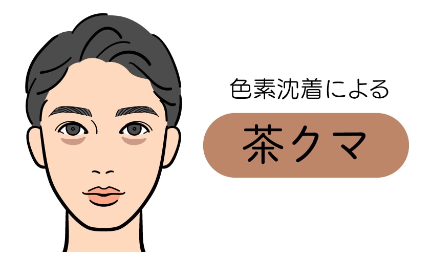 色素沈着による「茶クマ」