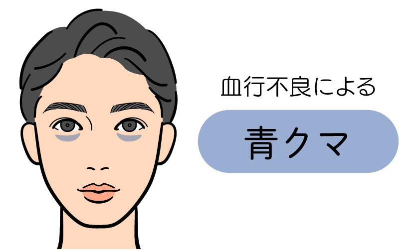 血行不良による「青クマ」