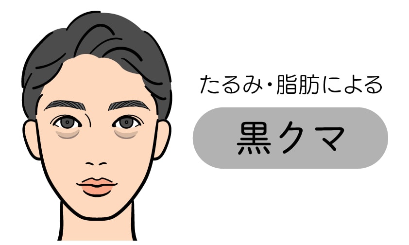 たるみ・脂肪による「黒クマ」