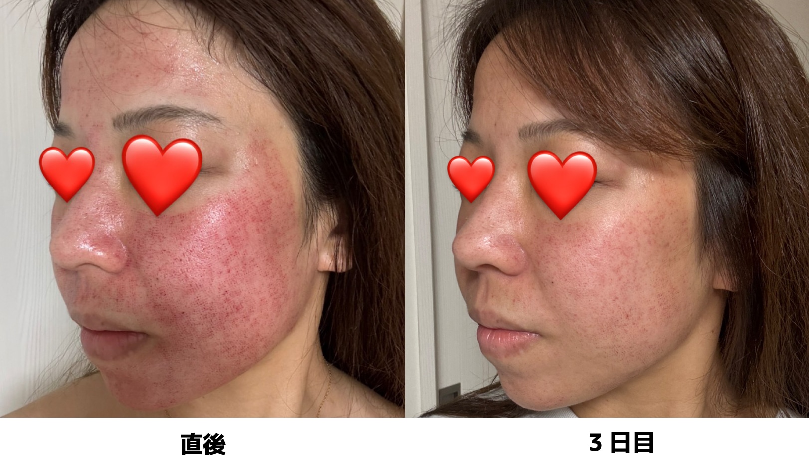 湘南 美容 外科 ピコ トーニング