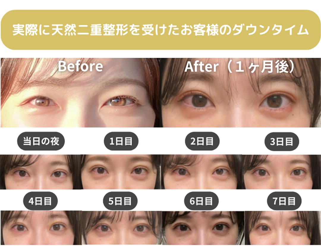 中山院長の二重整形の症例写真