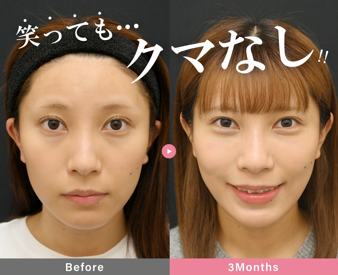 裏ハムラ法 症例写真
