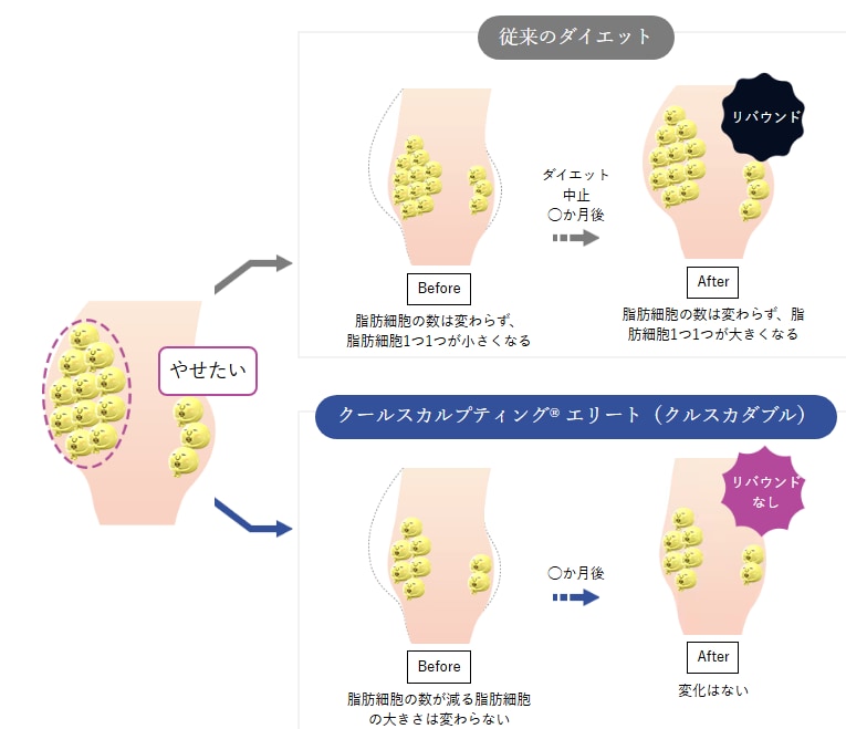 クールスカルプティングとは