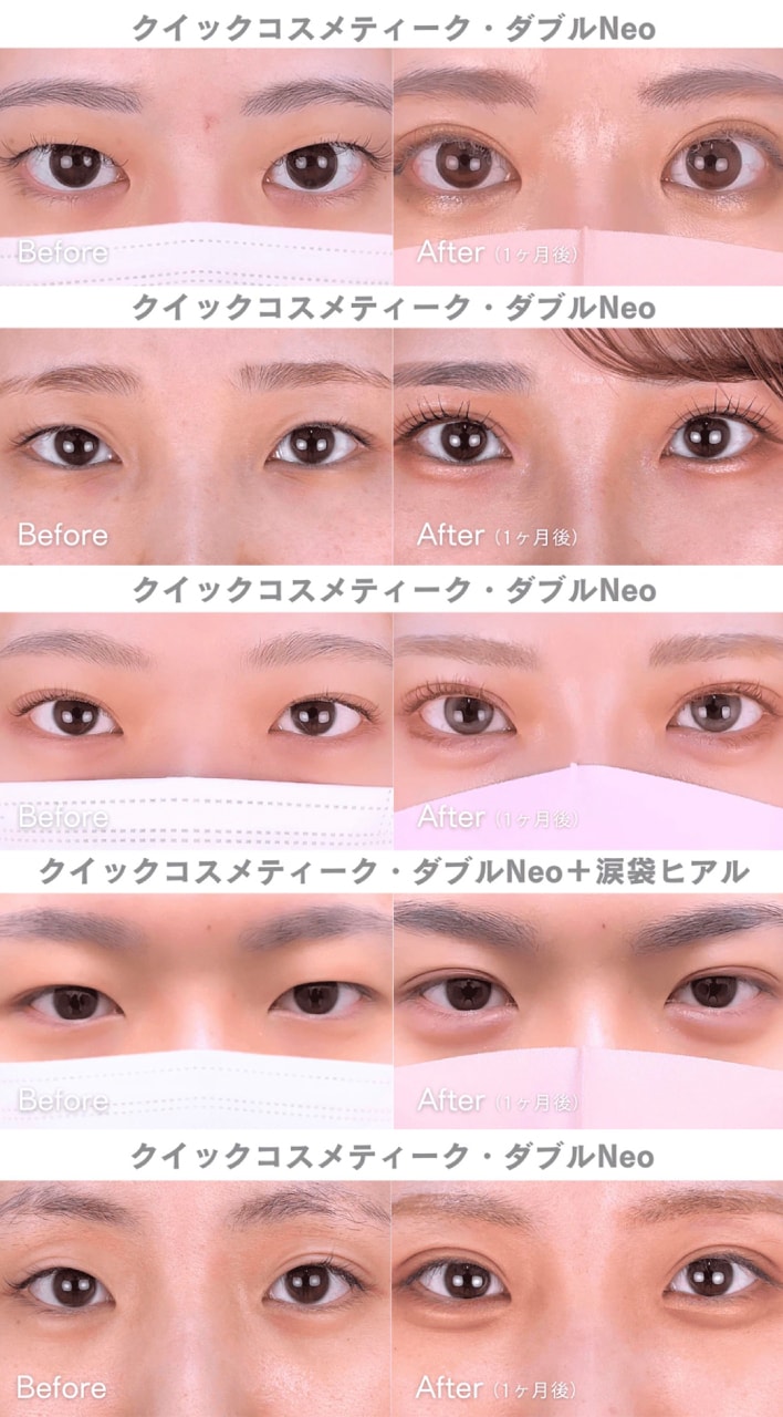 埋没二重のピックアップ症例