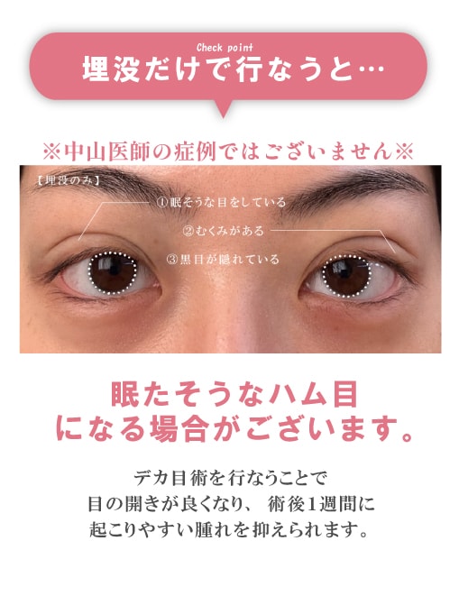 埋没法だけで行うと、眠そうなハム目になる可能性があるという解説画像