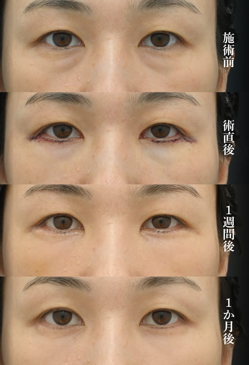 切開ハムラ法の症例