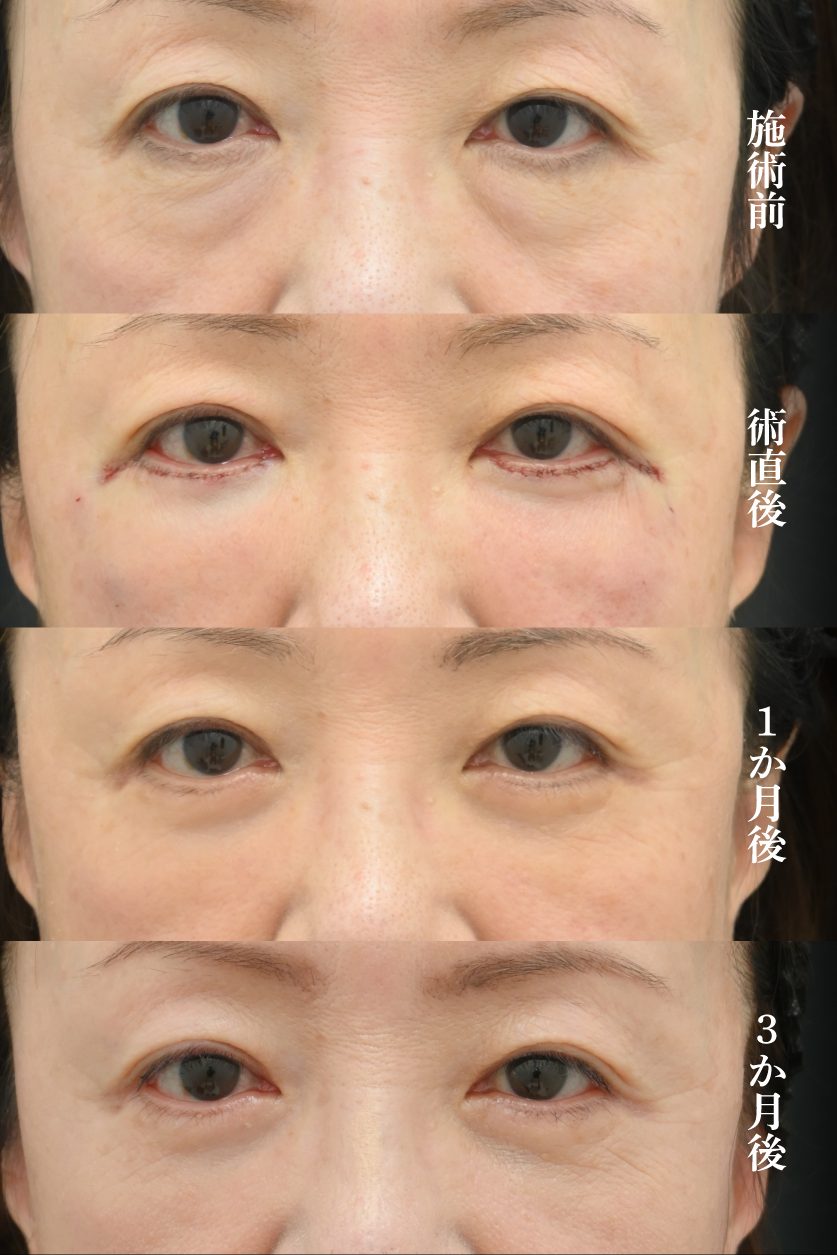 アイバックリムーブ法の症例１