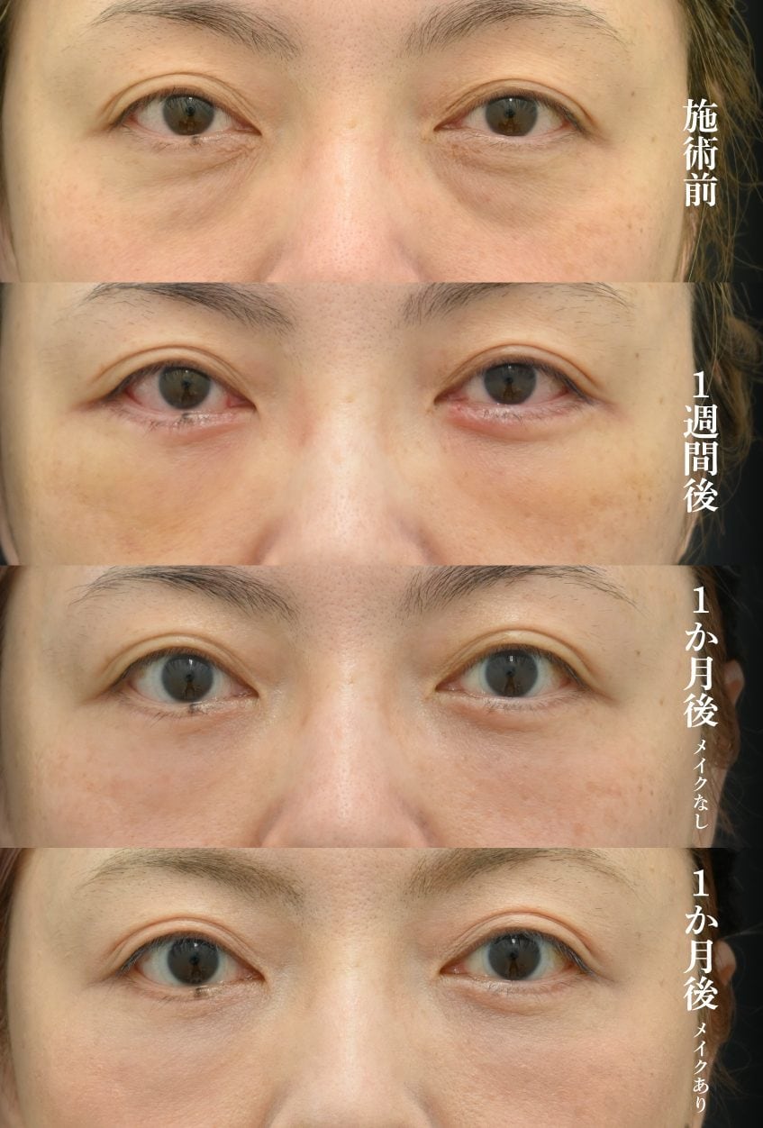 切開ハムラ法の症例2