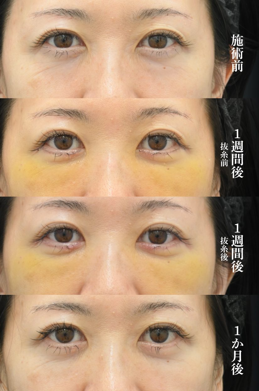 アイバックリムーブ法の症例２