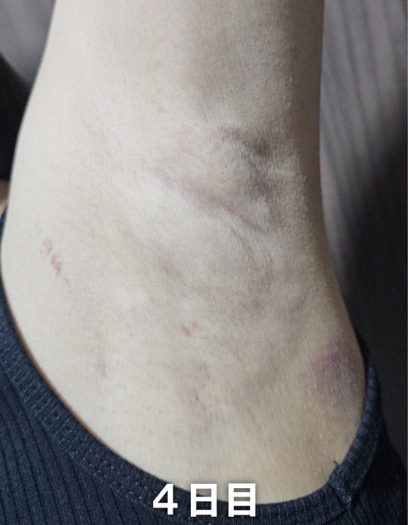 【施術後 4日目】