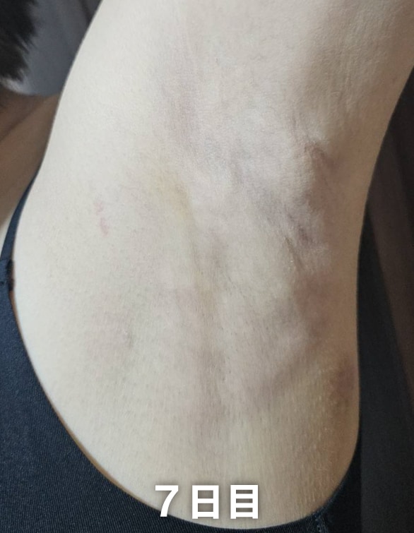 【施術後 6日目と2週間後】