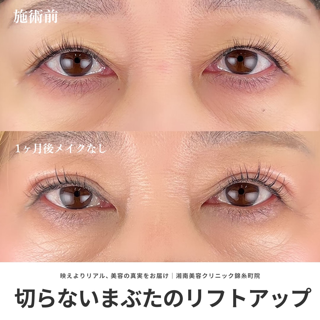 切らないまぶたのリフトアップ|30代・40代から始める埋没二重術!ミドル・シニア世代から人気!切らない眼瞼下垂術も【湘南美容クリニック錦糸町院】