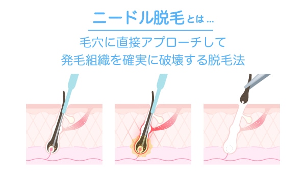 毛根を一つずつ直接破壊する、最も確実な永久脱毛法です。