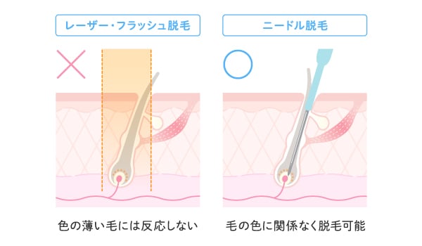 ニードル脱毛と医療レーザー脱毛を徹底比較！<br />
