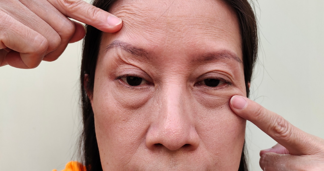 切らないまぶたのリフトアップとは？