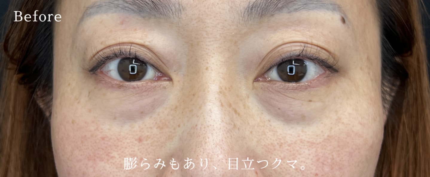 清水春花医師でクマ取りを。