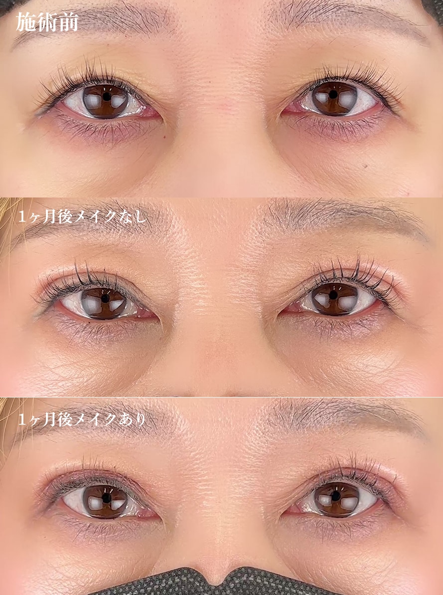 切らないまぶたのリフトアップ50代の症例