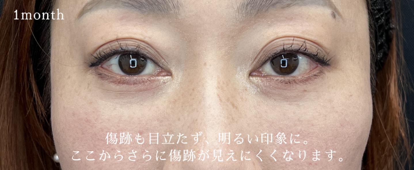 清水春花医師でクマ取りを。