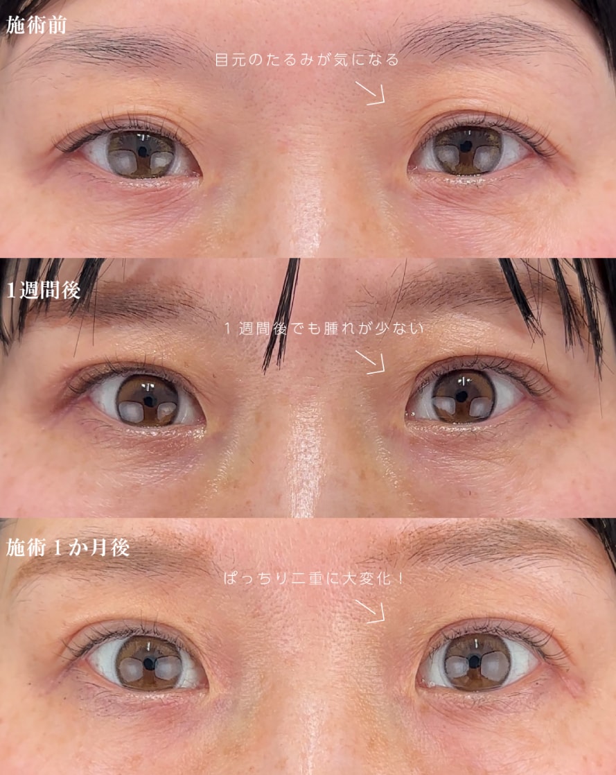 切らないまぶたのリフトアップ40代の症例