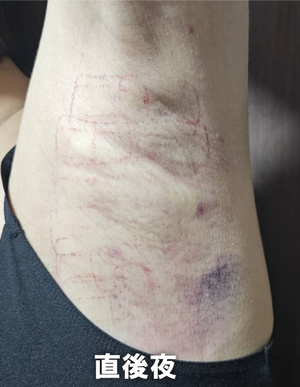 【施術当日〜翌日】