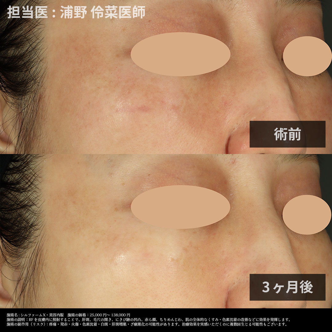 術後3ヶ月で肝斑が改善！