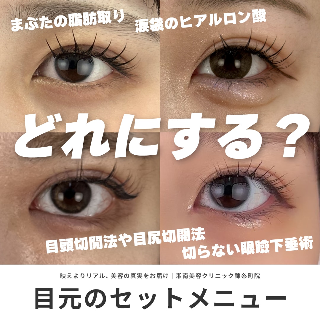 埋没法二重術と一緒に受けるべき施術とは？｜目頭切開法、目尻切開法、眼瞼下垂術、自然癒着セット（まぶたの脂肪取り）、クマ取り【湘南美容クリニック錦糸町院】