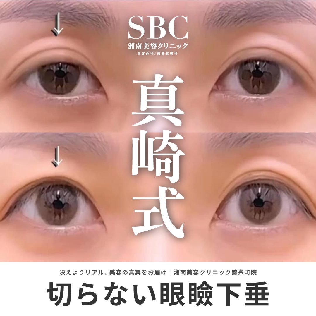 切らない眼瞼下垂（真崎式）とは？【リスク・ダウンタイム・価格】徹底解説｜湘南美容クリニック錦糸町院