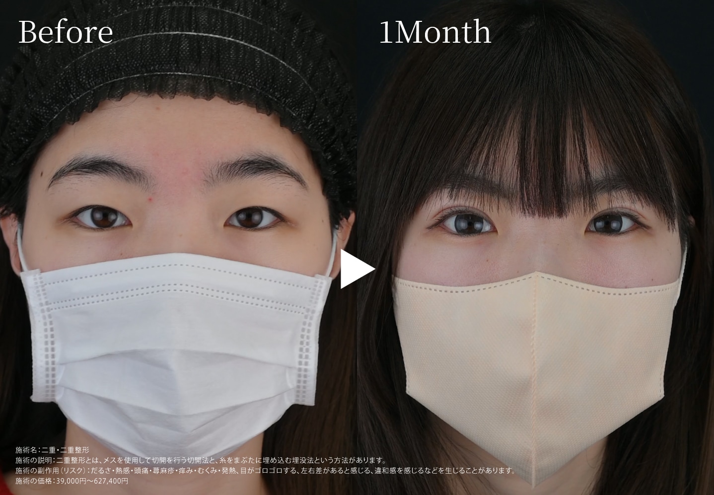 元々一重でも…