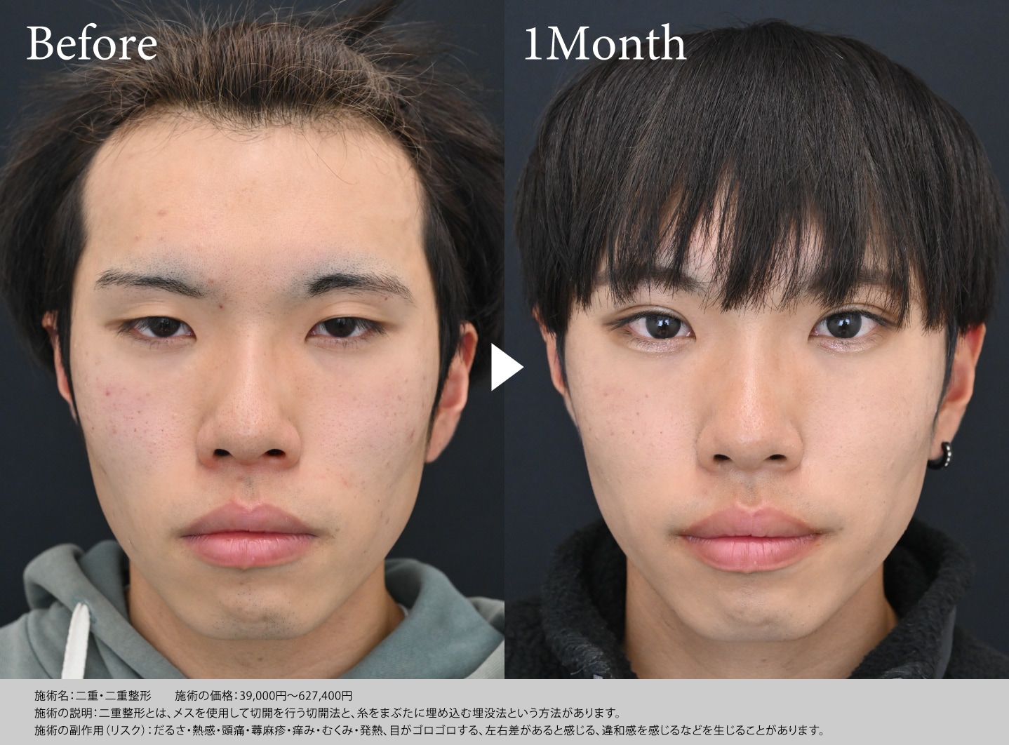 メンズ二重のビフォーアフター