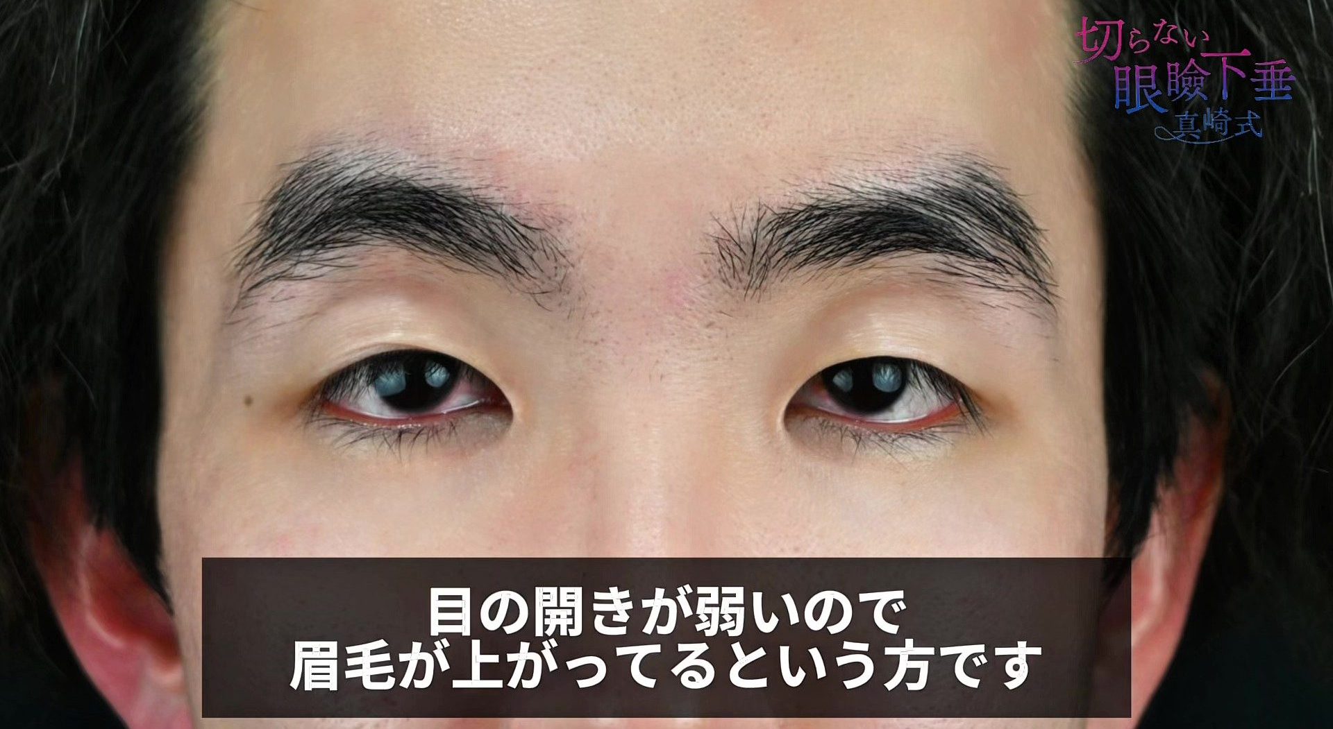 📸術前：20代男性の中等度眼瞼下垂