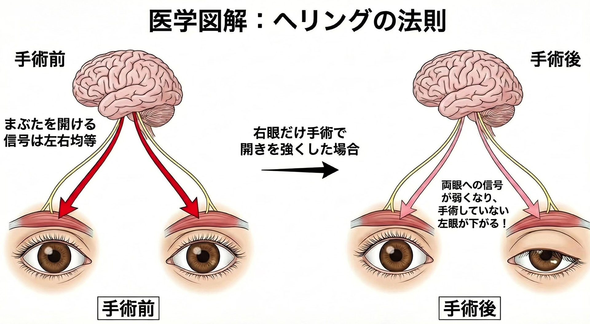 👀「ヘリング現象」による左右差について