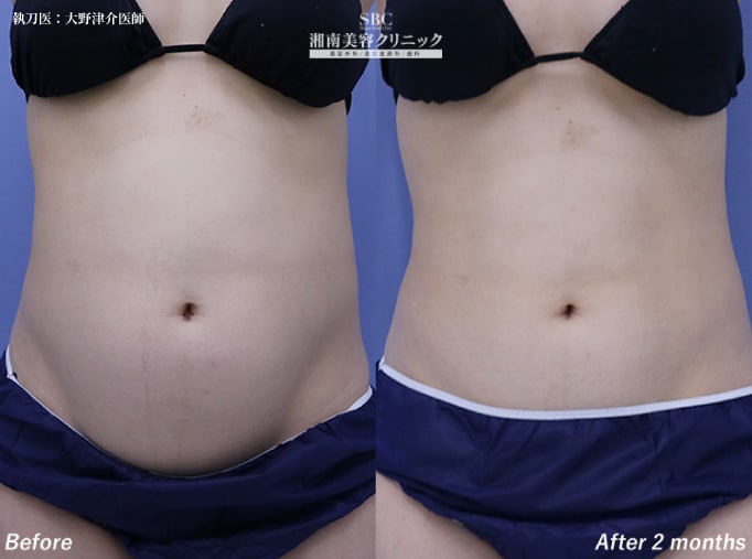 部分痩せを実感できるまでの期間 ⏳