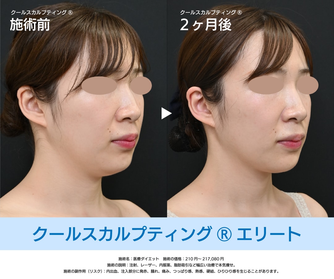 寝ているだけで部分痩せ！クールスカルプティング